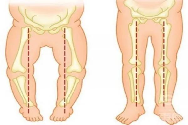 宝宝走路内八字怎么办？家庭矫正就是这么简单